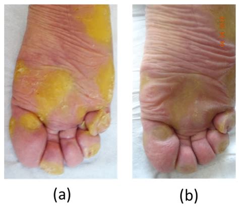 Treatment of Painful Palmoplantar Keratoderma Related to